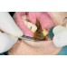 Set of Dental Implant Locator Depth Pin Gauge Guide Locating Plate S-type L-type
